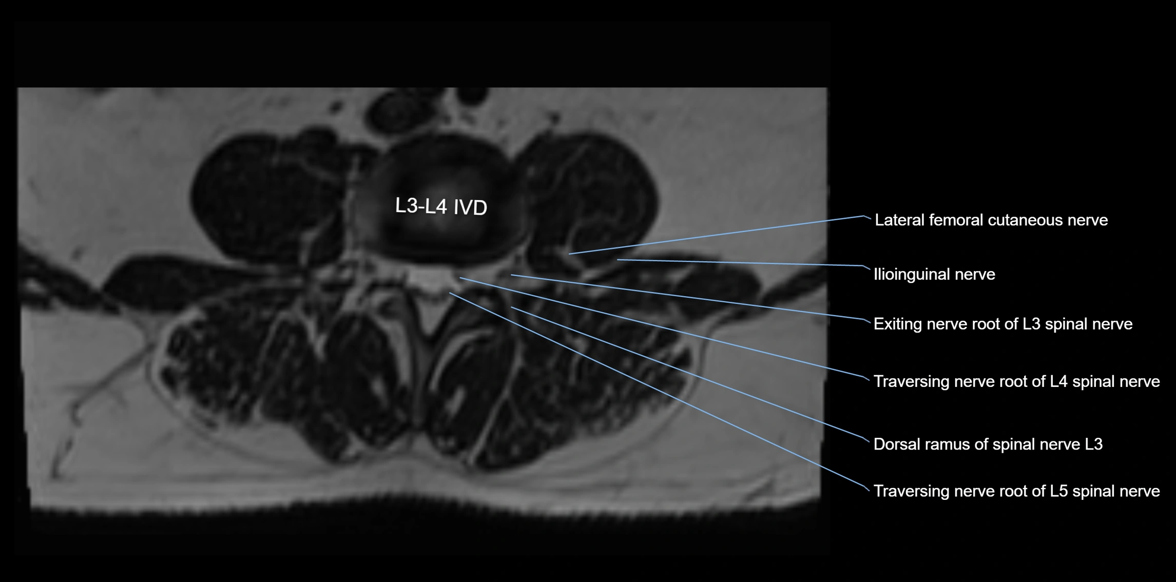 MR lumbosacral plexus axial cross sectional anatomy 3T  radiology  image-img-1008001-00028.webp